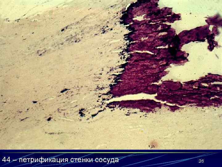 44 – петрификация стенки сосуда 26 