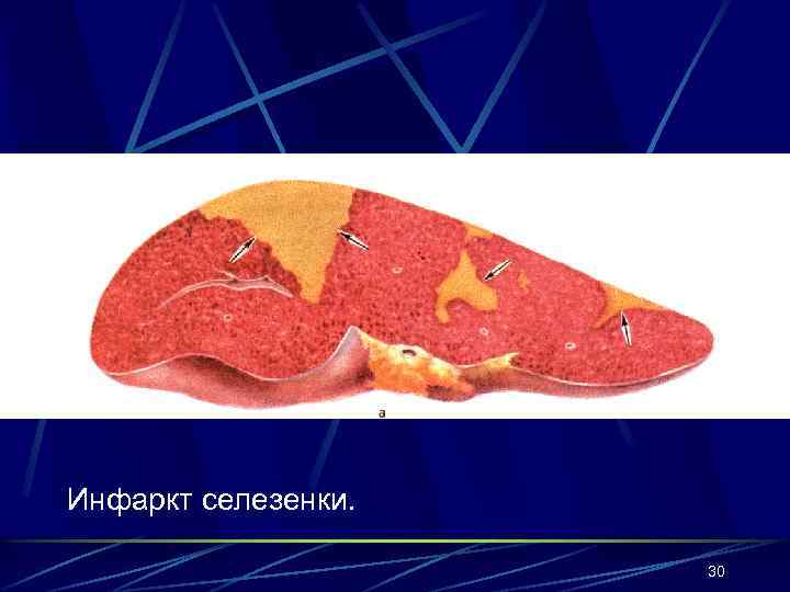 Инфаркт селезенки. 30 
