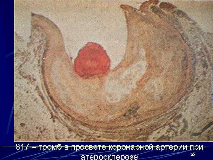 817 – тромб в просвете коронарной артерии при 32 атеросклерозе 