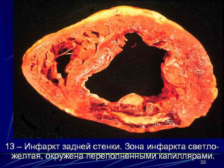 13 – Инфаркт задней стенки. Зона инфаркта светложелтая, окружена переполненными капиллярами. 33 