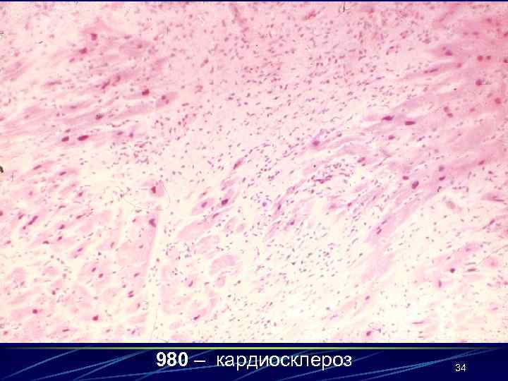 980 – кардиосклероз 34 