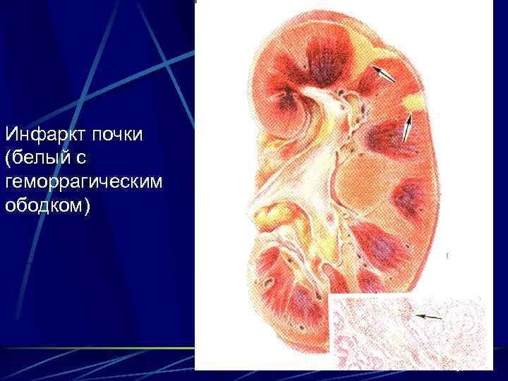 Инфаркт почки (белый с геморрагическим ободком) 37 