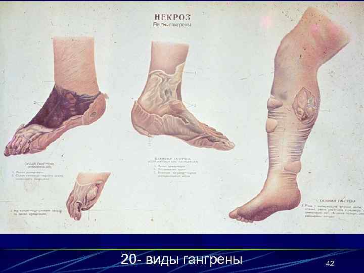 20 - виды гангрены 42 