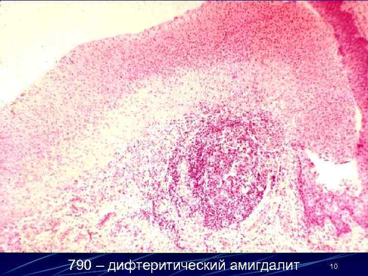 790 – дифтеритический амигдалит 10 
