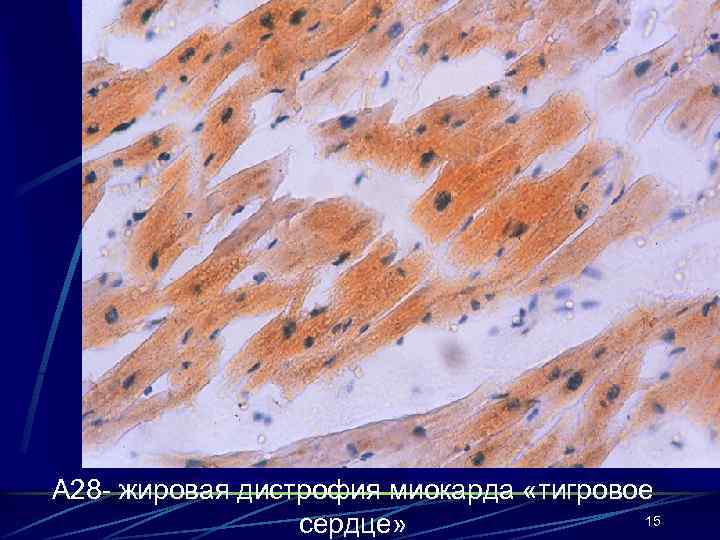 А 28 - жировая дистрофия миокарда «тигровое 15 сердце» 
