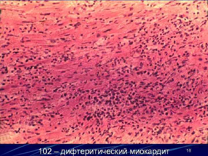 102 – дифтеритический миокардит 16 