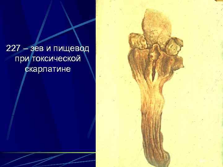 227 – зев и пищевод при токсической скарлатине 24 