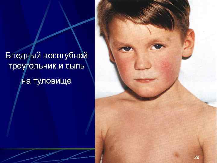 Бледный носогубной треугольник и сыпь на туловище 28 