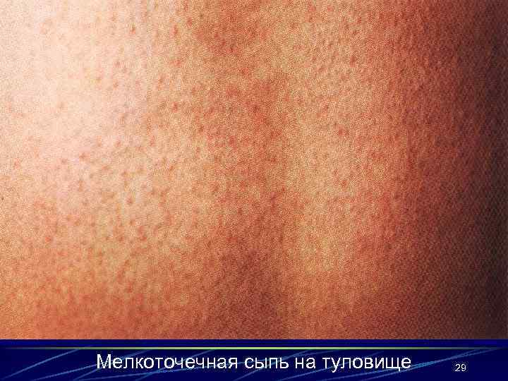 Мелкоточечная сыпь на туловище 29 