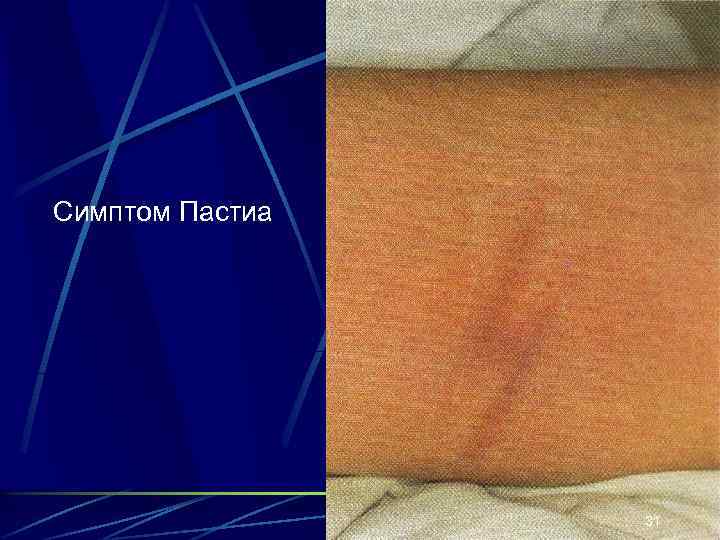 Симптом Пастиа 31 