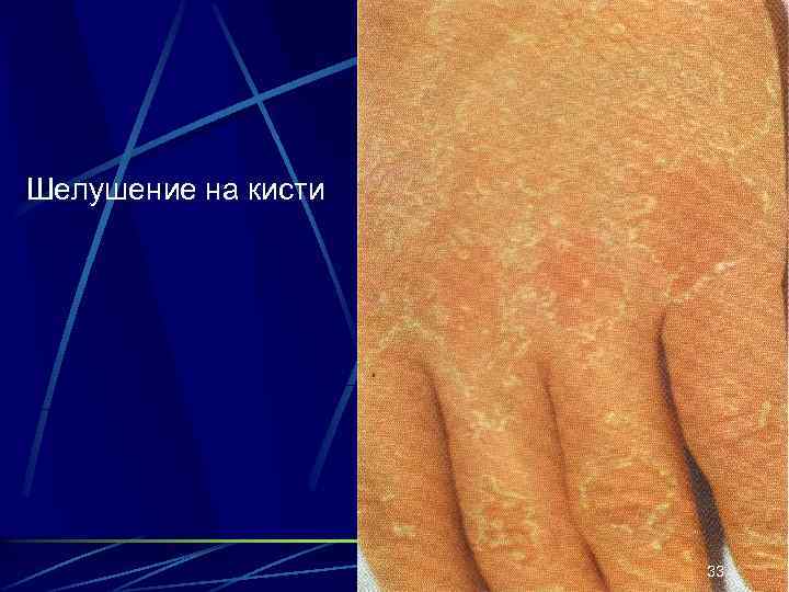 Шелушение на кисти 33 