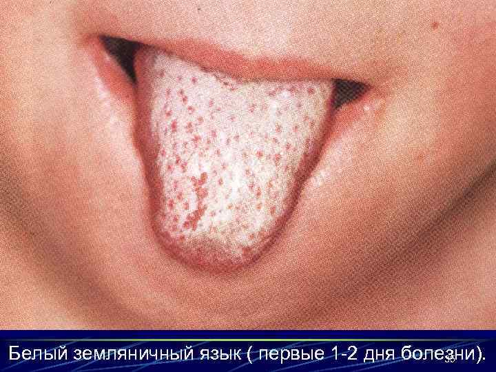 Белый земляничный язык ( первые 1 -2 дня болезни). 35 