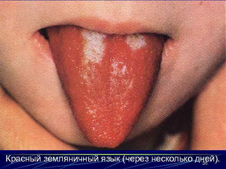 Красный земляничный язык (через несколько дней). 36 