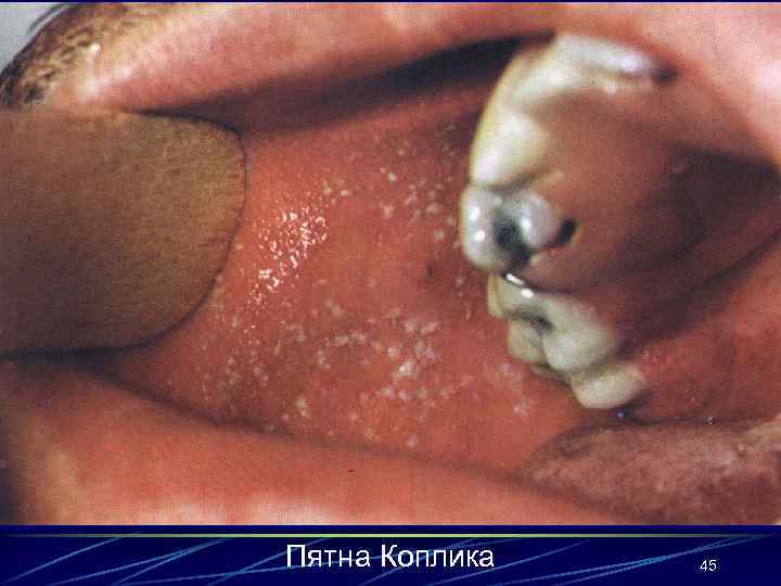 Пятна Коплика 45 