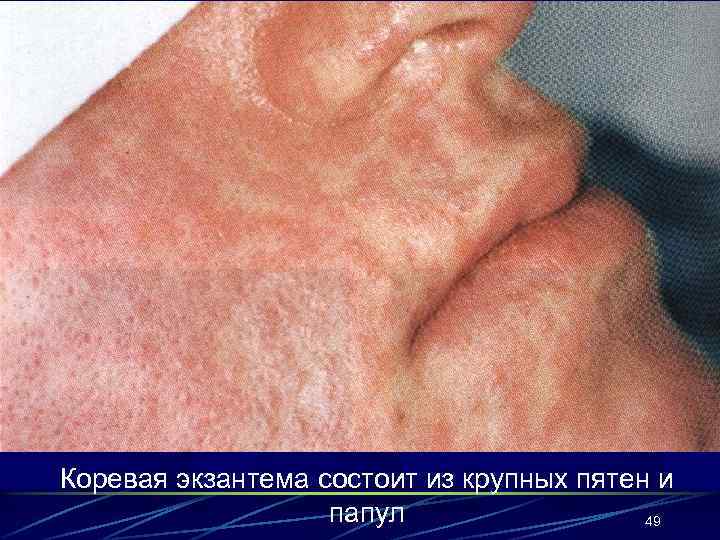 Коревая экзантема состоит из крупных пятен и папул 49 