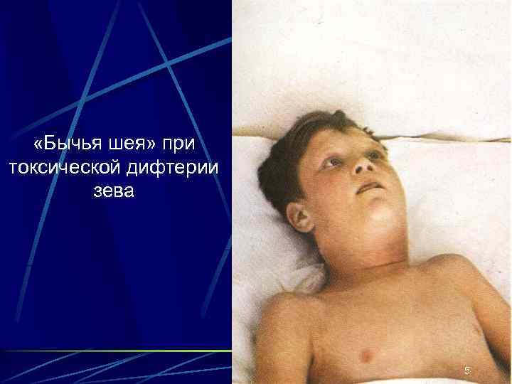  «Бычья шея» при токсической дифтерии зева 5 