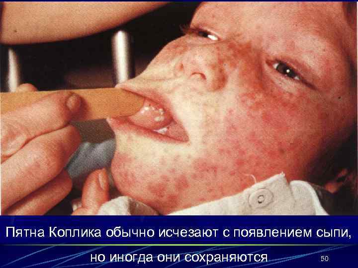 Пятна Коплика обычно исчезают с появлением сыпи, но иногда они сохраняются 50 