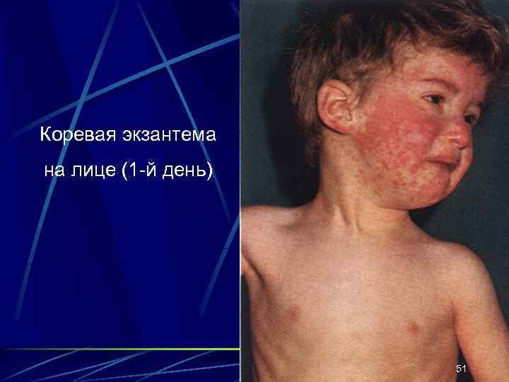 Коревая экзантема на лице (1 -й день) 51 