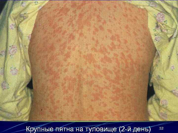 Крупные пятна на туловище (2 -й день) 52 