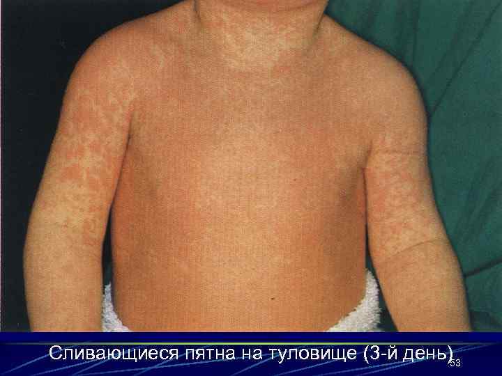 Сливающиеся пятна на туловище (3 -й день)53 