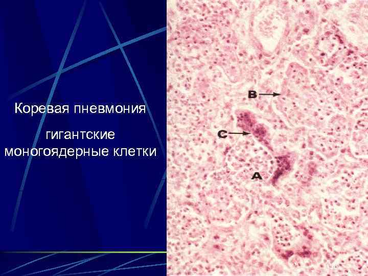 Коревая пневмония гигантские моногоядерные клетки 56 