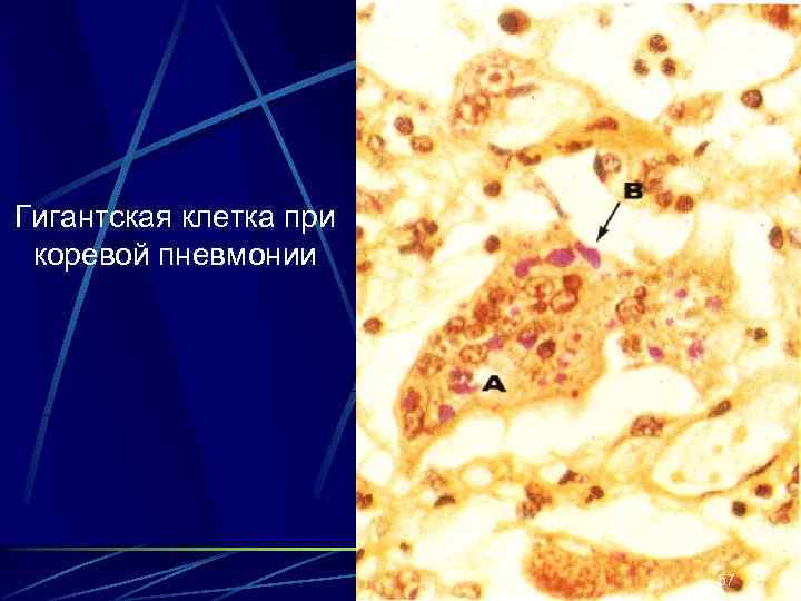 Гигантская клетка при коревой пневмонии 57 