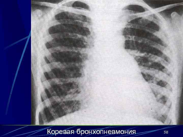 Коревая бронхопневмония 58 