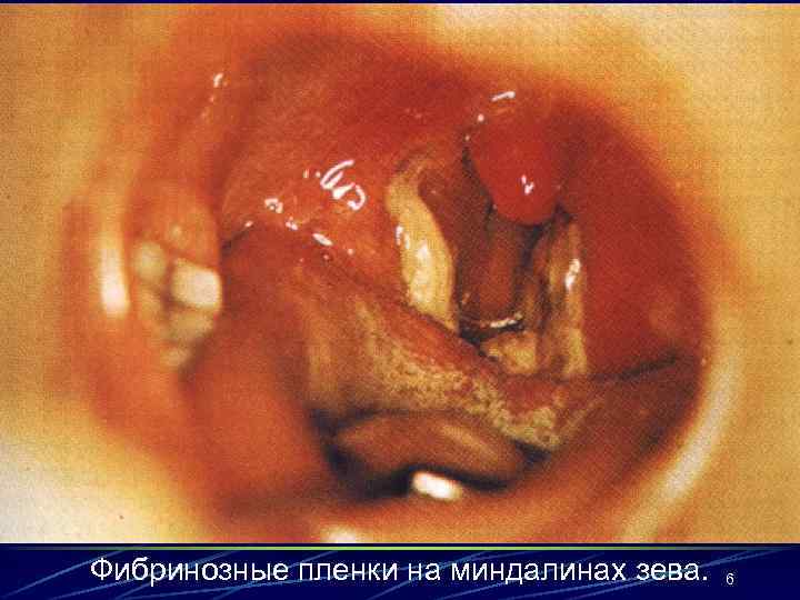 Фибринозные пленки на миндалинах зева. 6 
