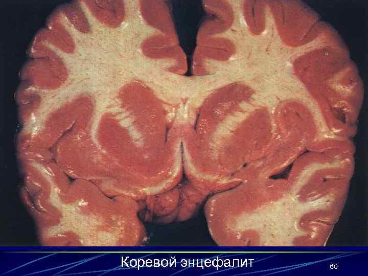 Коревой энцефалит 60 