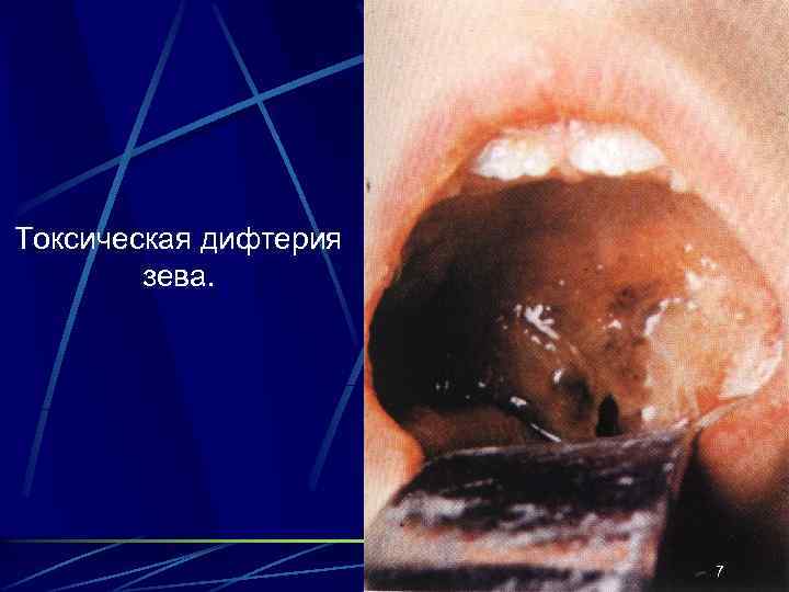 Токсическая дифтерия зева. 7 