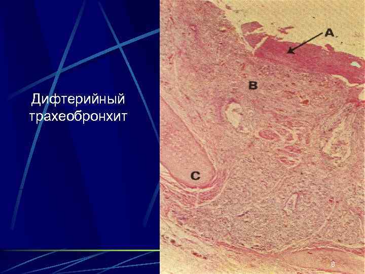 Дифтерийный трахеобронхит 8 