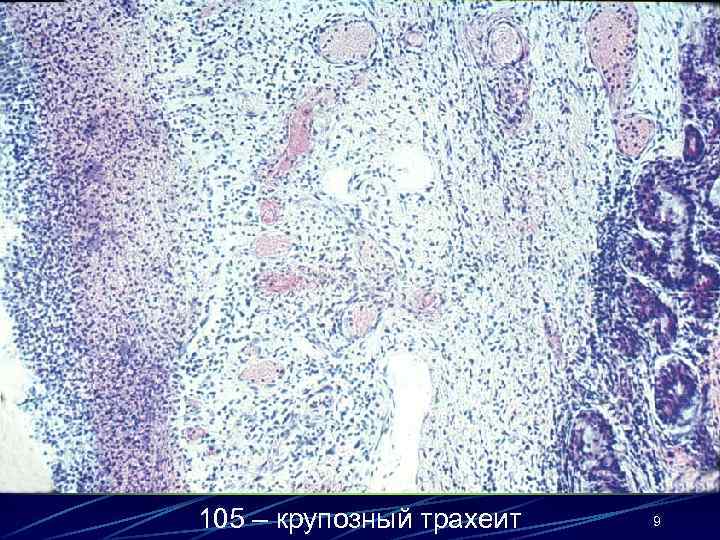 105 – крупозный трахеит 9 