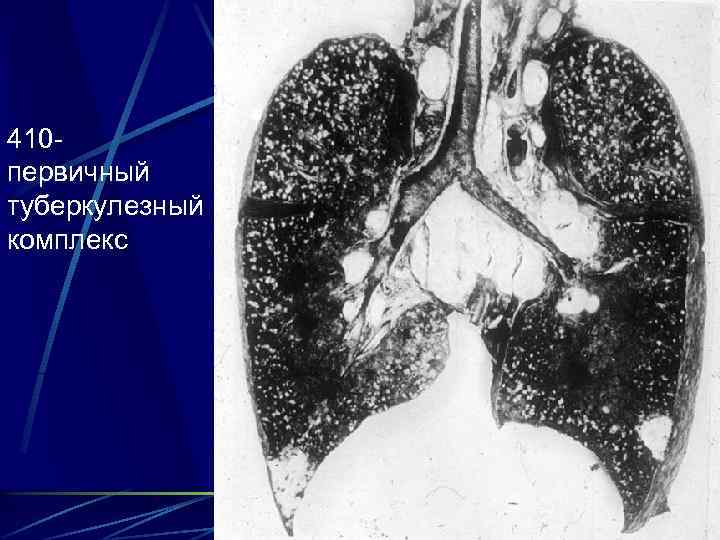 410 первичный туберкулезный комплекс 