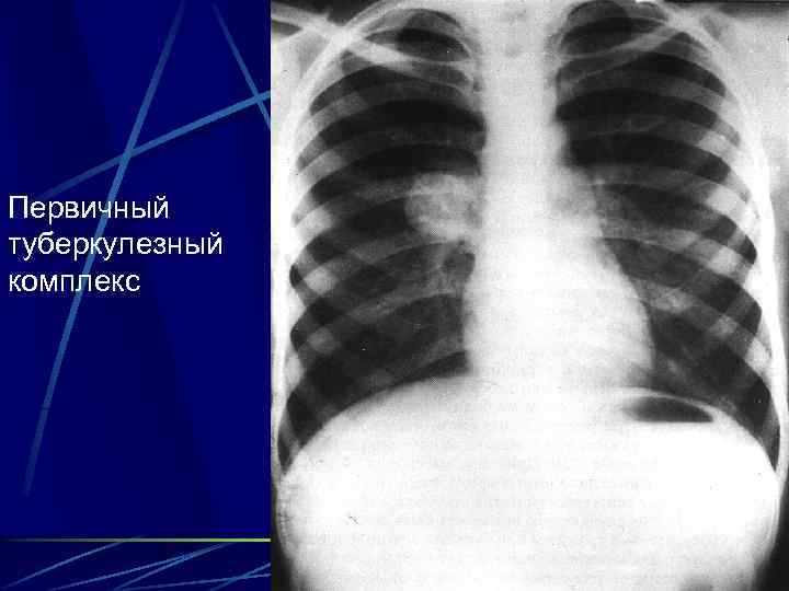 Первичный туберкулезный комплекс 