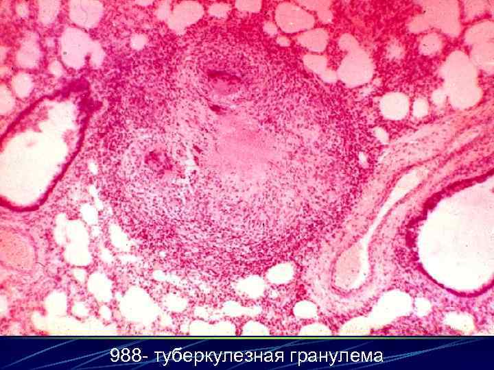 988 - туберкулезная гранулема 