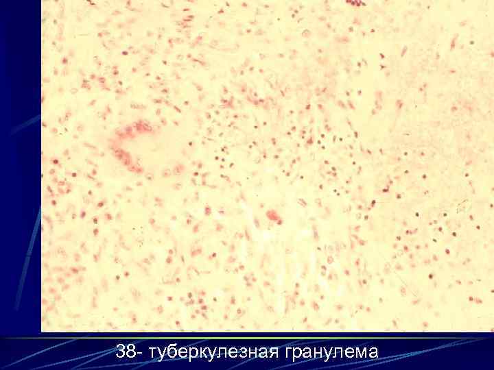 38 - туберкулезная гранулема 