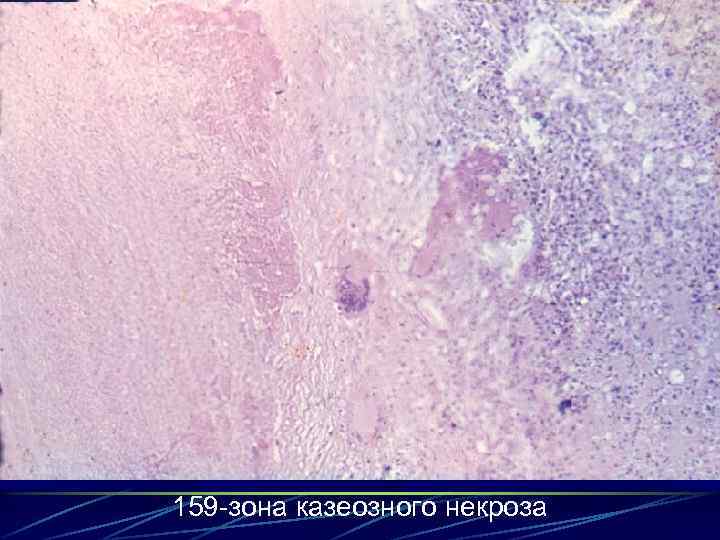 159 -зона казеозного некроза 