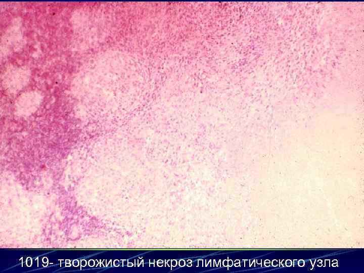 1019 - творожистый некроз лимфатического узла 