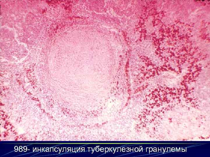 989 - инкапсуляция туберкулезной гранулемы 
