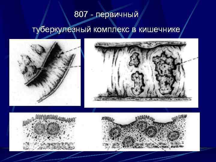807 - первичный туберкулезный комплекс в кишечнике 