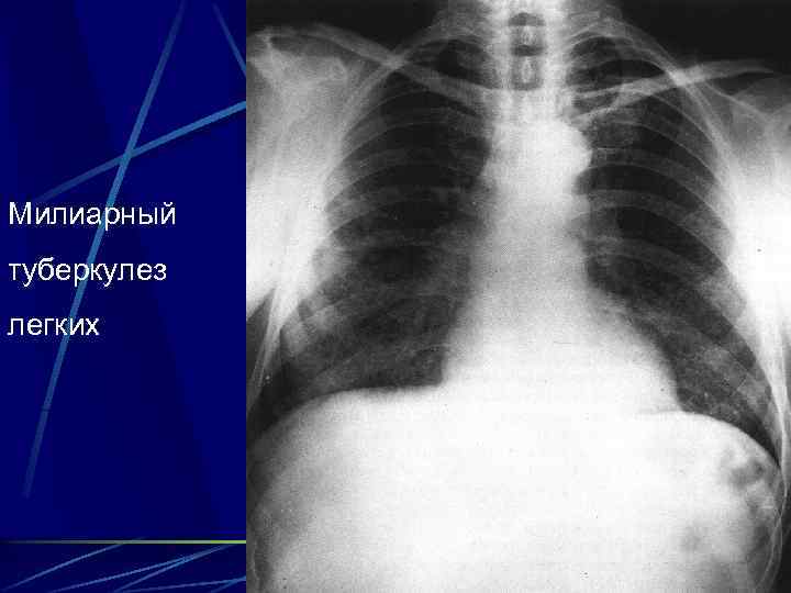 Милиарный туберкулез легких 