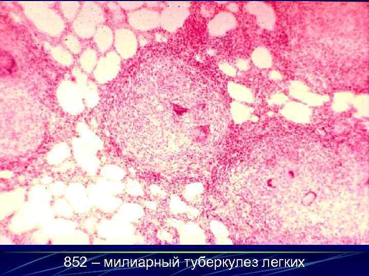 852 – милиарный туберкулез легких 