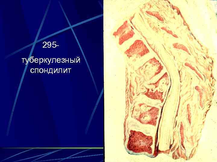 295 туберкулезный спондилит 