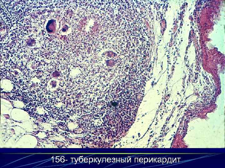 156 - туберкулезный перикардит 