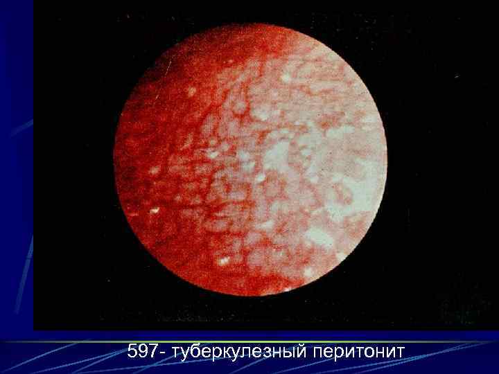 597 - туберкулезный перитонит 