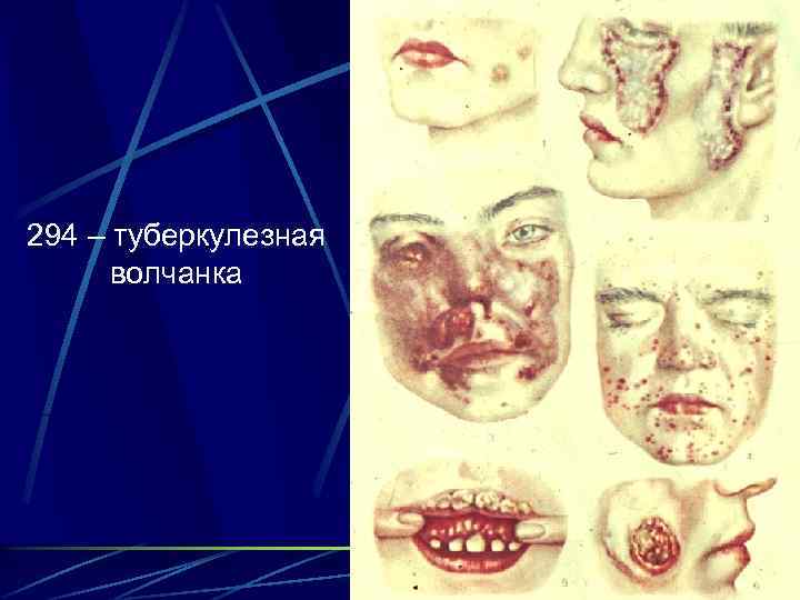 294 – туберкулезная волчанка 