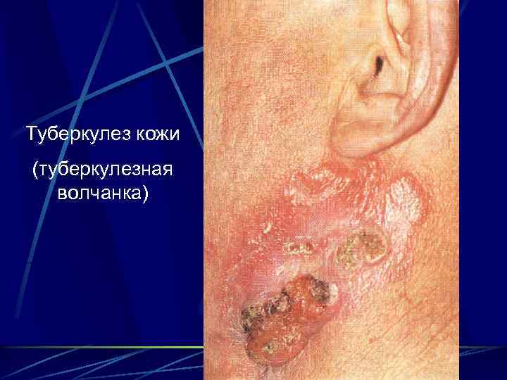 Туберкулез кожи (туберкулезная волчанка) 