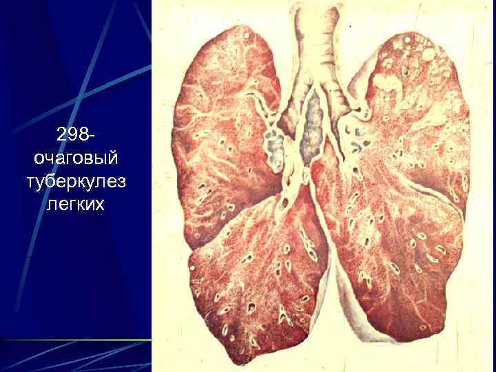 298 очаговый туберкулез легких 
