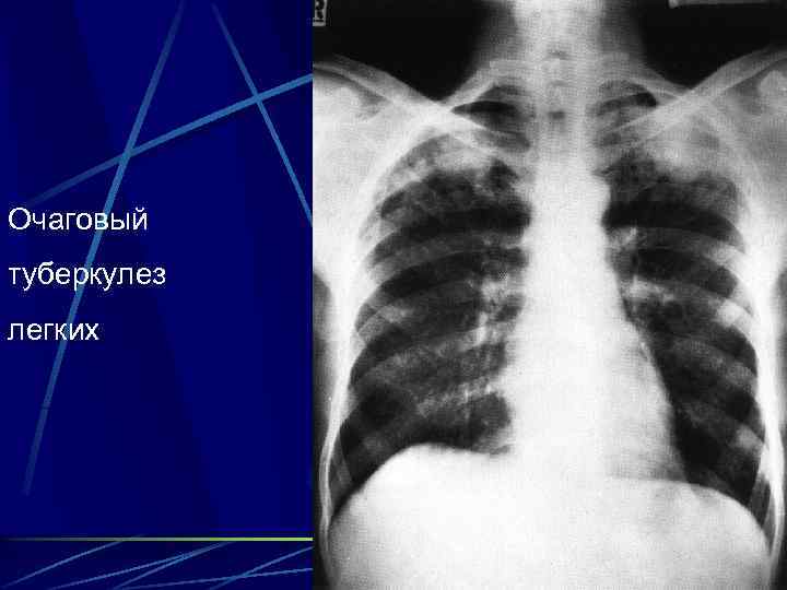 Очаговый туберкулез легких 