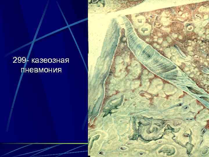 299 - казеозная пневмония 